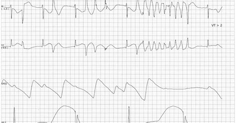 Float Nurse: Polymorphic VT