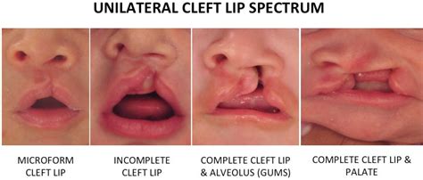 Cleft lip