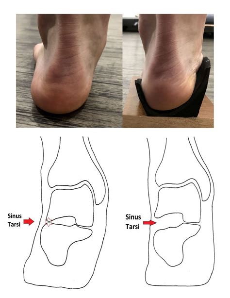 Sinus Tarsi Pain (Sinus Tarsi Syndrome) - Ankle, Foot and Orthotic Centre