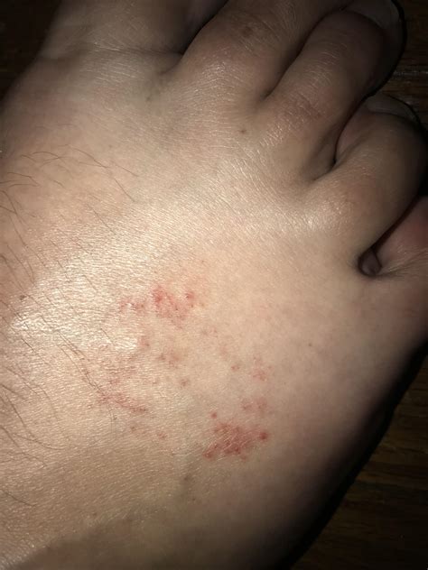 Rash on top of foot, raised small red bumps. Not itchy or painful. : r/Dermatology