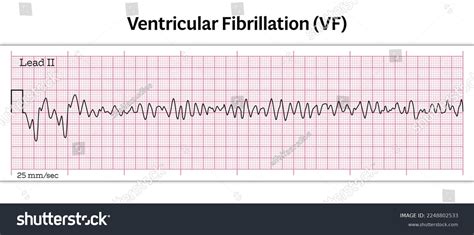 Rapid ventricular rate : 70 images, photos et images vectorielles de stock | Shutterstock