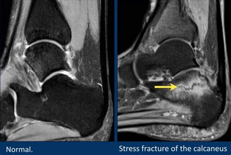 Abnormal Mri Of Foot Tendon