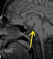 Tuber cinereum hamartoma-MRI - Sumer's Radiology Blog