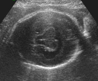 Semilobar Holoprosencephaly | Medical ultrasound, Ultrasound sonography, Obstetric ultrasound