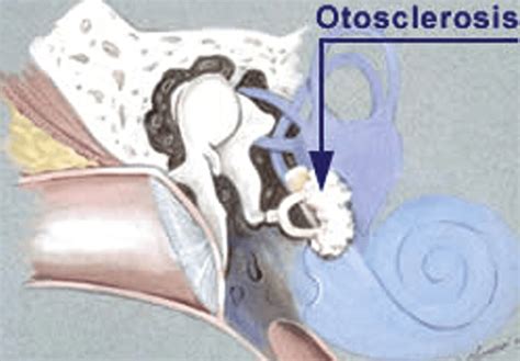 Otosclerosis: Diagnosis, Evaluation, Pathology, Surgical Techniques ...