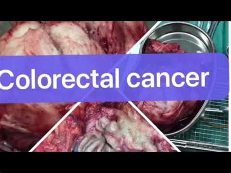 Colorectal cancer surgery - YouTube