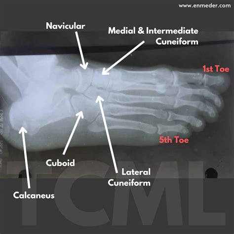 Tarsal bone - TCML - The Charsi of Medical Literature