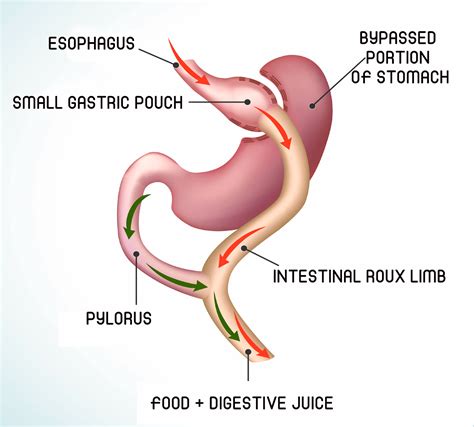 Roux En Y Gastric Bypass