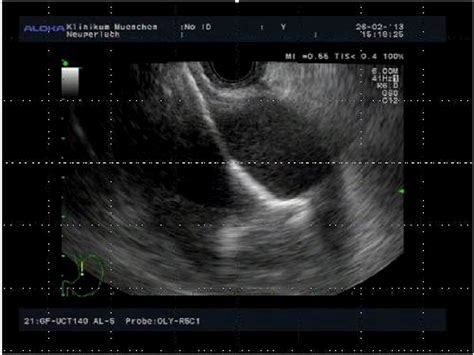 Mo1461 EUS-Guided Drainage of Pseudocysts or Pancreatic Necrosis Using ...