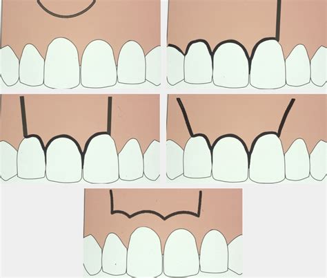 10+ Root End Resection - RoseannToby