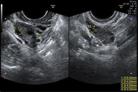 Ovarian Follicle Ultrasound