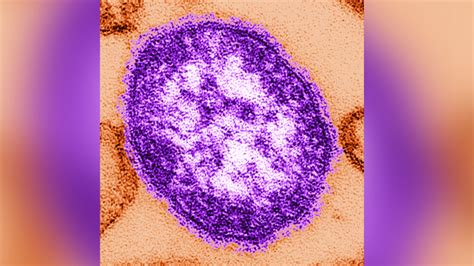 Why you should, and shouldn't, worry about measles | Fox News