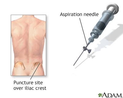 Bone marrow biopsy Information | Mount Sinai - New York