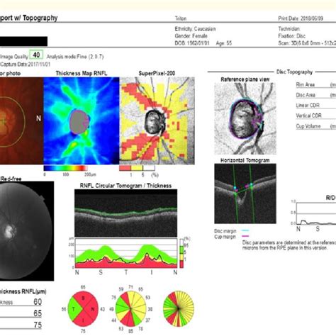 Print out of SS-OCT scan of same patient showing peripapillary RNFL... | Download Scientific Diagram