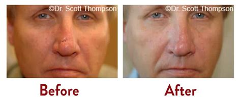 Scar Revision Treatment Salt Lake City UT | Utah Facial Plastics
