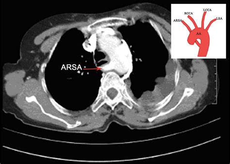 Cureus | Anatomical Variations of the Aortic Arch: A Computerized Tomography-Based Study