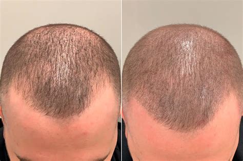 Scalp Micropigmentation photos | Miami, FL | Patient59740