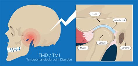 TMJ Treatments: Effective Solutions for Temporomandibular Joint Disorders