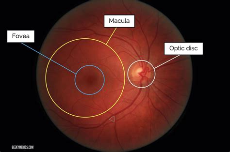 Fundoscopic Appearances of Retinal Pathologies | Geeky Medics