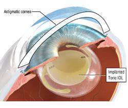 Astigmatism Surgery | Astigmatism Correction | FLEI.com