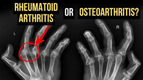 Rheumatoid Arthritis vs Osteoarthritis - Explained - YouTube