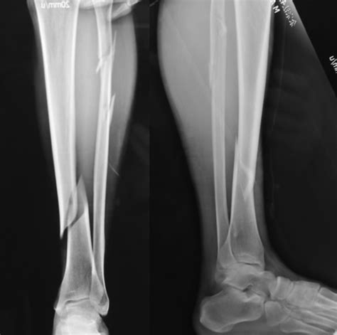 Tibial Fracture X Ray