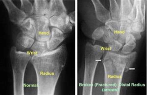 Wrist Fractures – Surgically Dr. George Morrison