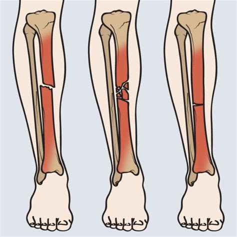 Types of tibia fracture – Welcome to SYS MEDTECH INTERNATIONAL PRIVATE LIMITED