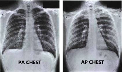 Normal Chest Xray Labeled