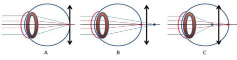 Illustration of an emmetropic eye that has undergone modication of its... | Download Scientific ...