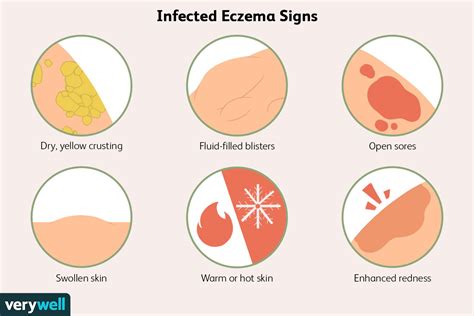 Infected Eczema: Symptoms, Pictures, and Treatment