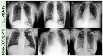 Bronchopneumonia Chest X Ray