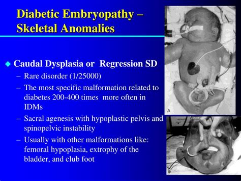 PPT - Infant of the Diabetic Mother PowerPoint Presentation, free ...