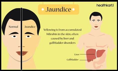 Jaundice Treatment at best price in Firozabad | ID: 9069357762