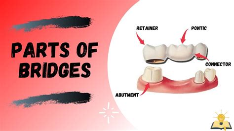 Fixed Partial Dentures