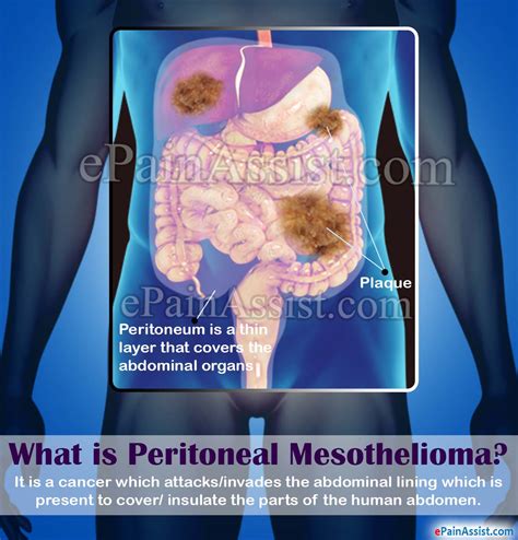 What is Peritoneal Mesothelioma|Causes|Signs|Symptoms|Diagnosis