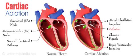 Cardiac Ablation - Procedure, Risks and Benefits