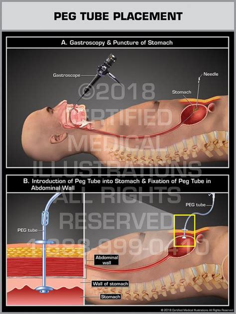 PEG Tube Placement (Percutaneous Endoscopic Gastrostomy) - Print ...