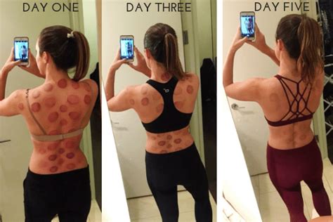 Cupping Therapy Q & A | Carly A. Hill