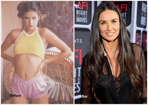 Demi Moore Plastic surgery Demi Moore before and after photo