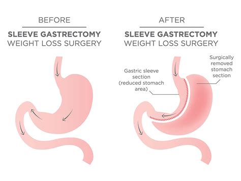 A/Prof Jaber | Gastric Sleeve Surgery | Wollongong