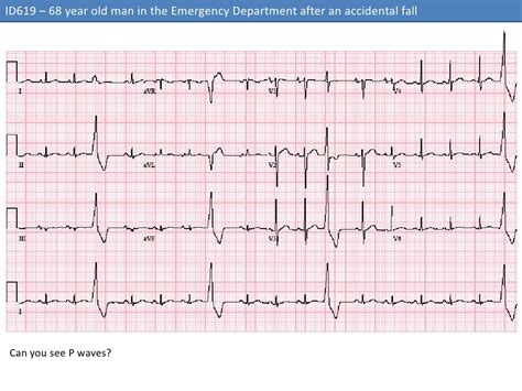 Premature Ventricular Complexes