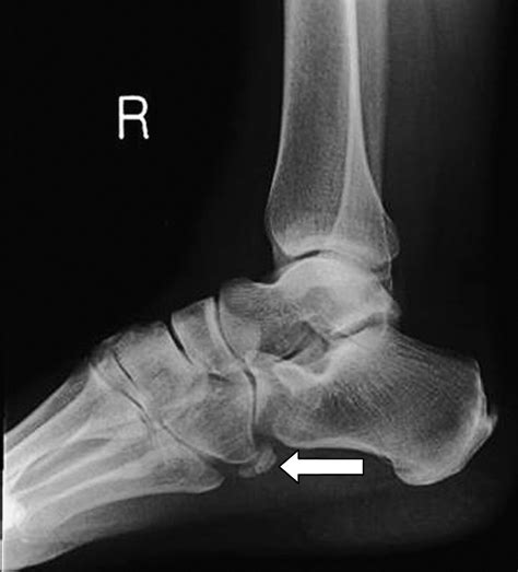 The Importance of Magnetic Resonance Imaging in a Symptomatic “Bipartite” Os Peroneum: A Case ...