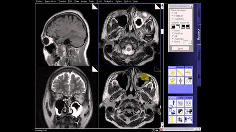 [DIAGRAM] Diagram Of Sinuses Mri - MYDIAGRAM.ONLINE