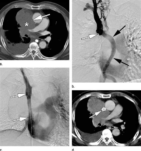 Malignant SVC syndrome due to small cell carcinoma in a 65-year-old... | Download Scientific Diagram