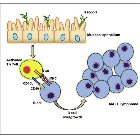 (PDF) MALT GASTRIC LYMPHOMA: AN UPDATE OF PATHOGENETIC FEATURES