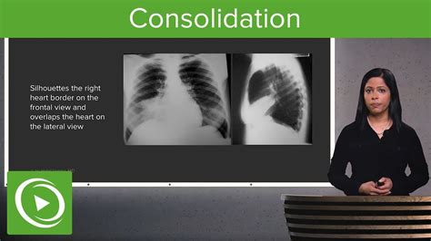 Consolidation – Radiology | Lecturio - YouTube