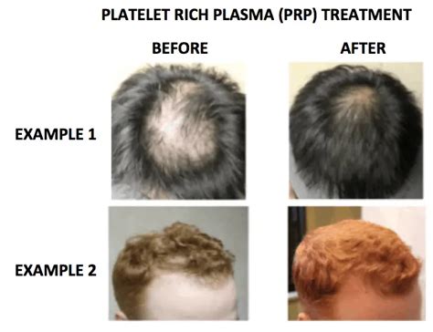 PRP for Hair Loss: Growth Results, Costs & Side Effects - Bald & Beards