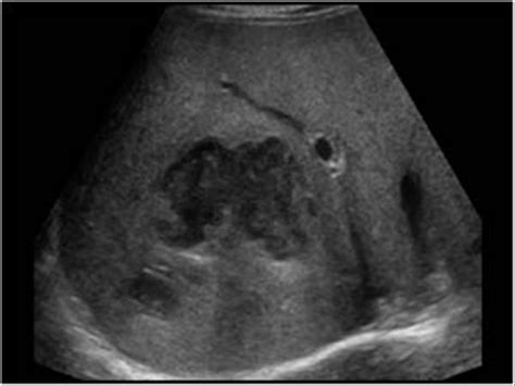 Abdomen and retroperitoneum | 1.1 Liver : Case 1.1.6 Liver abscesses | Ultrasound Cases