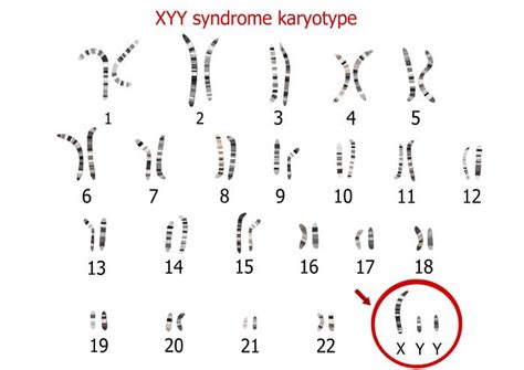 Turner Syndrome Xo Chromosome - maeteroch